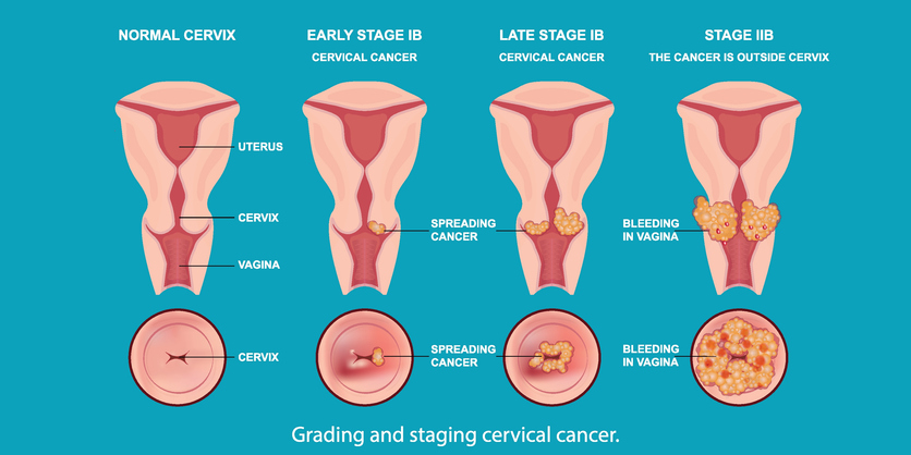cervical cancer stages