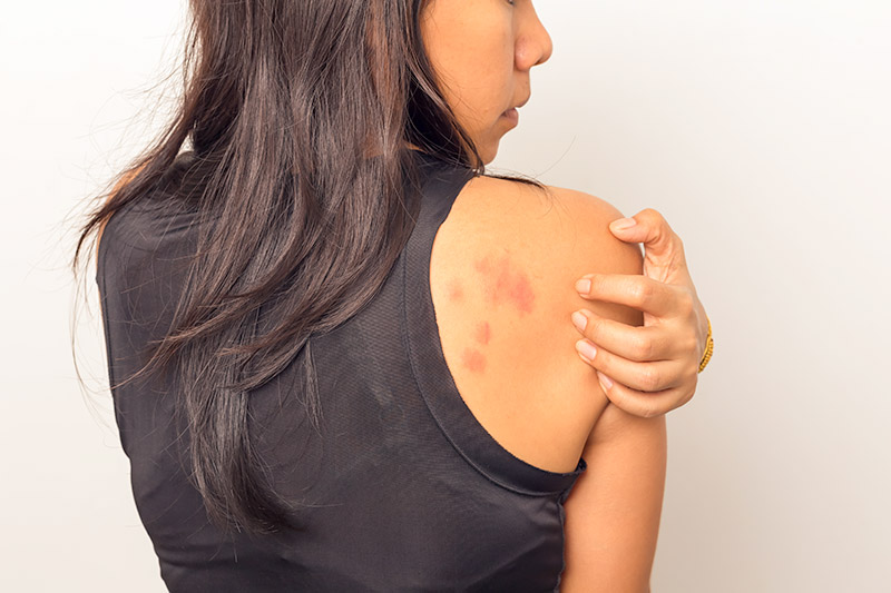 woman with rash on the back of her shoulder