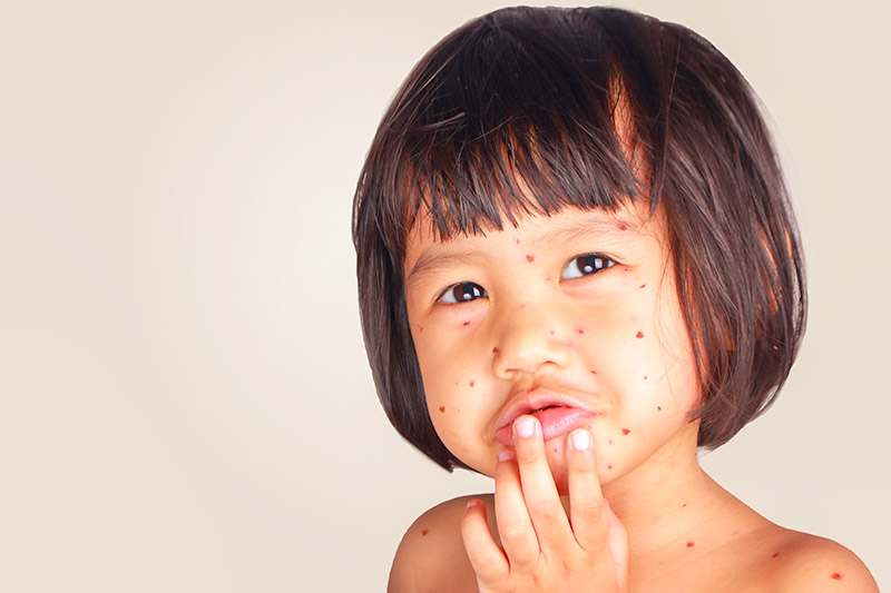 Young girl with rash on her face