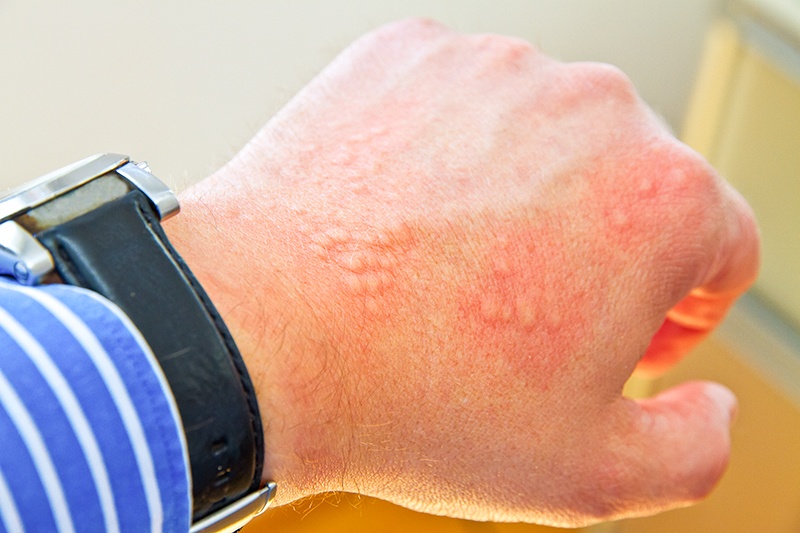 Male with allergic reaction on the skin of his hand