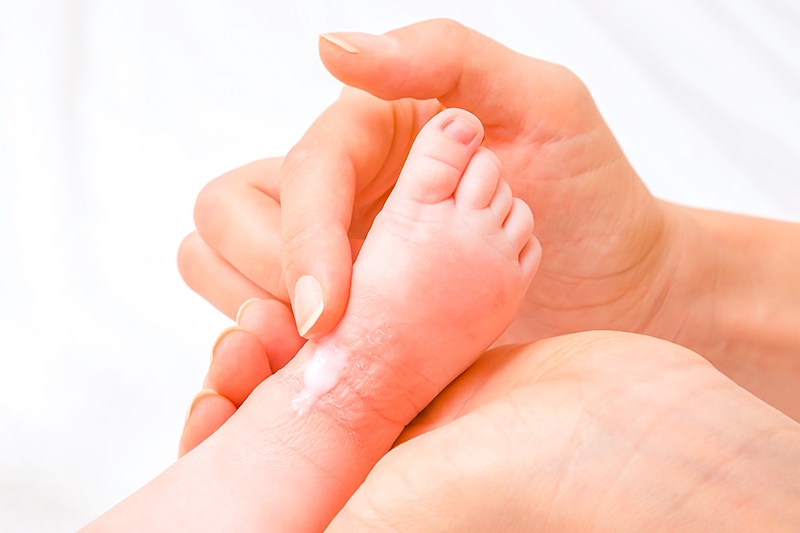 child's foot with allergic reaction. Mother rubbing ointment on skin