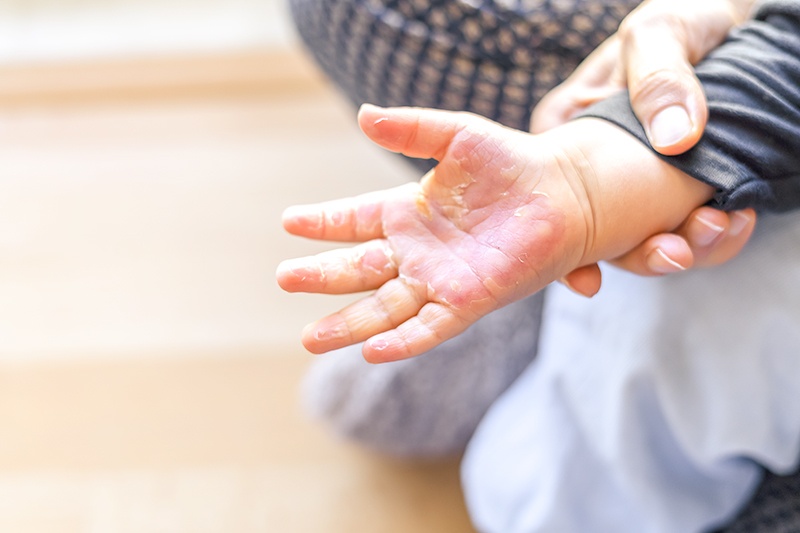 young child with burn on hand