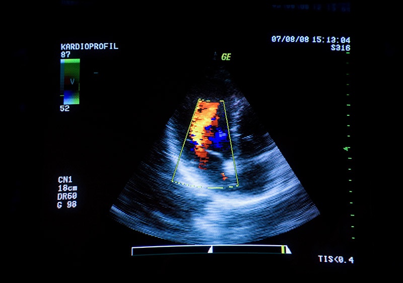 heart ultrasound
