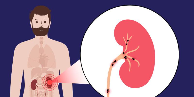 Kidney Stones: Emergency Department Diagnosis And Treatment