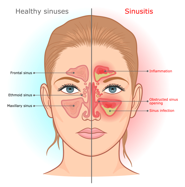 graphic showing healthy sinuses vs sinusitis
