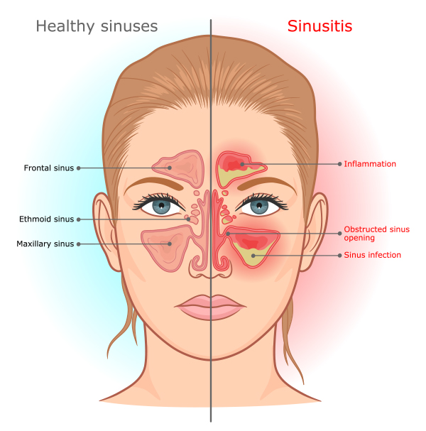 Sinus infection on sale jaw pain