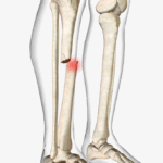 A human leg with a noticeable red spot showing a tibia bone fracture