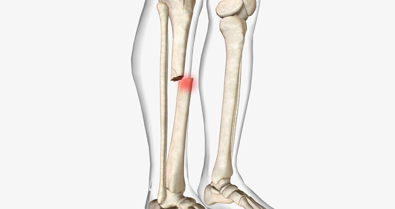 Tibia Bone Fractures: Causes, Symptoms, Diagnosis & Recovery