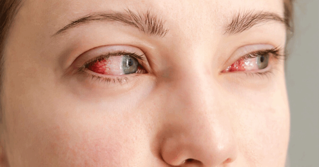 Close-up of a person's eyes with redness and irritation, showing symptoms of eye burn or possible infection.