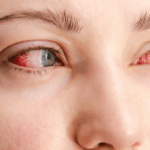 Close-up of a person's eyes with redness and irritation, showing symptoms of eye burn or possible infection.