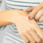 A woman applying ointment to her burned skin for relief and healing