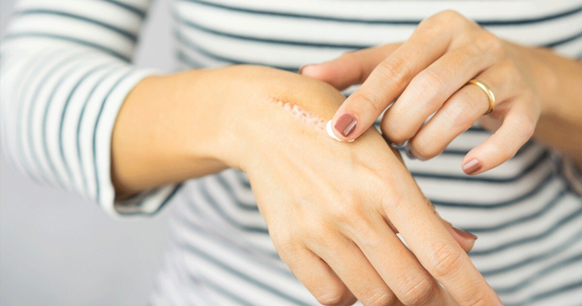 How to Treat a Burn on Your Hand from a Hot Pan