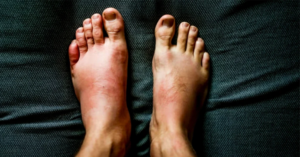 Swollen feet showing redness illustrating cause of foot swelling.