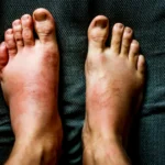 Swollen feet showing redness illustrating cause of foot swelling.