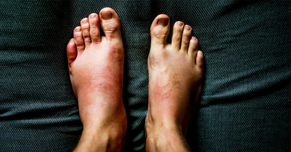What Is The Cause Of Swelling In The Feet?