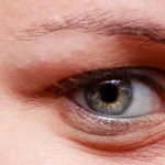 Close-up of mild swelling under one human eye.