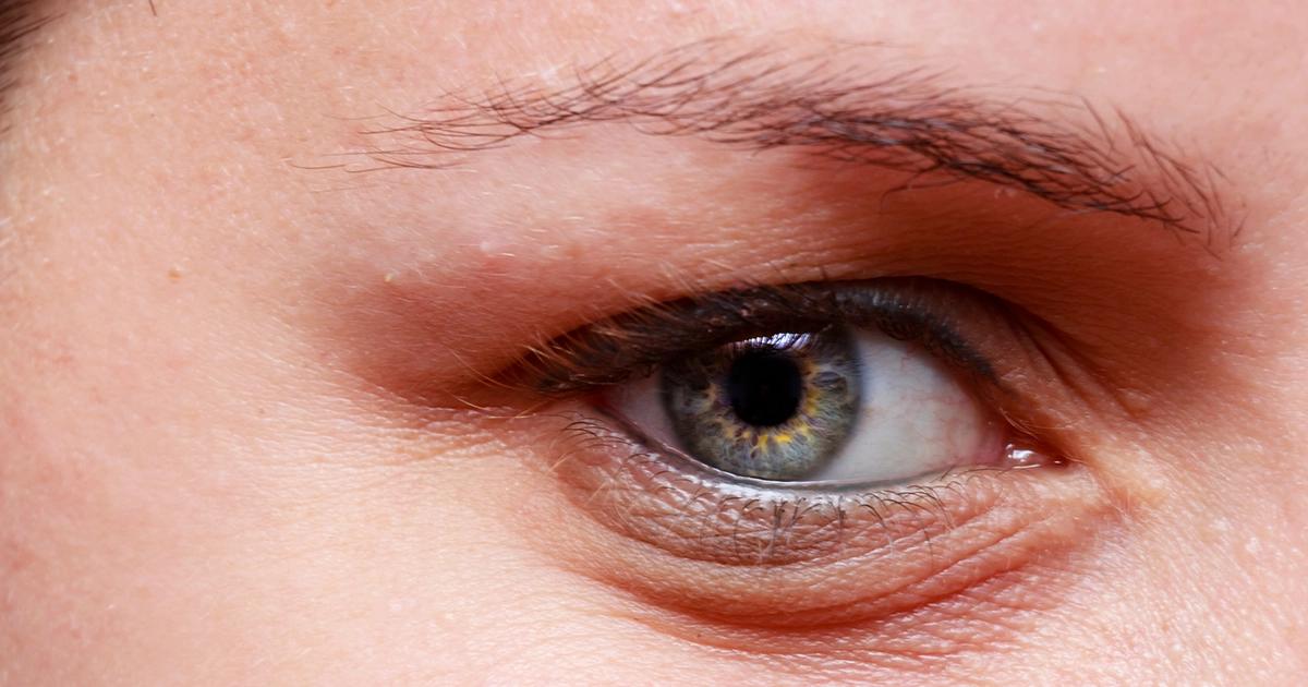 What Causes Swelling Under One Eye?