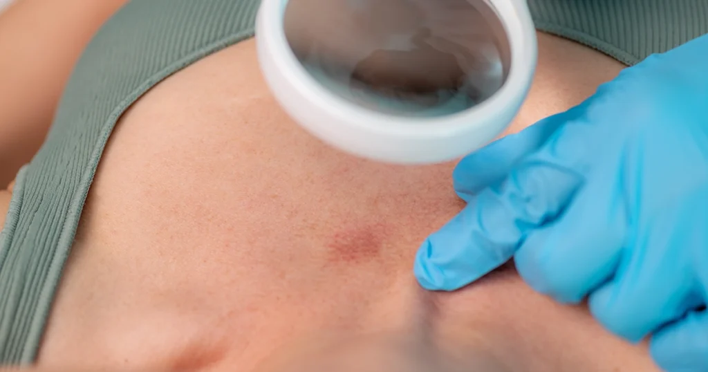 Doctor examining a skin lesion with magnifying tool and gloves.
