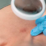 Doctor examining a skin lesion with magnifying tool and gloves.