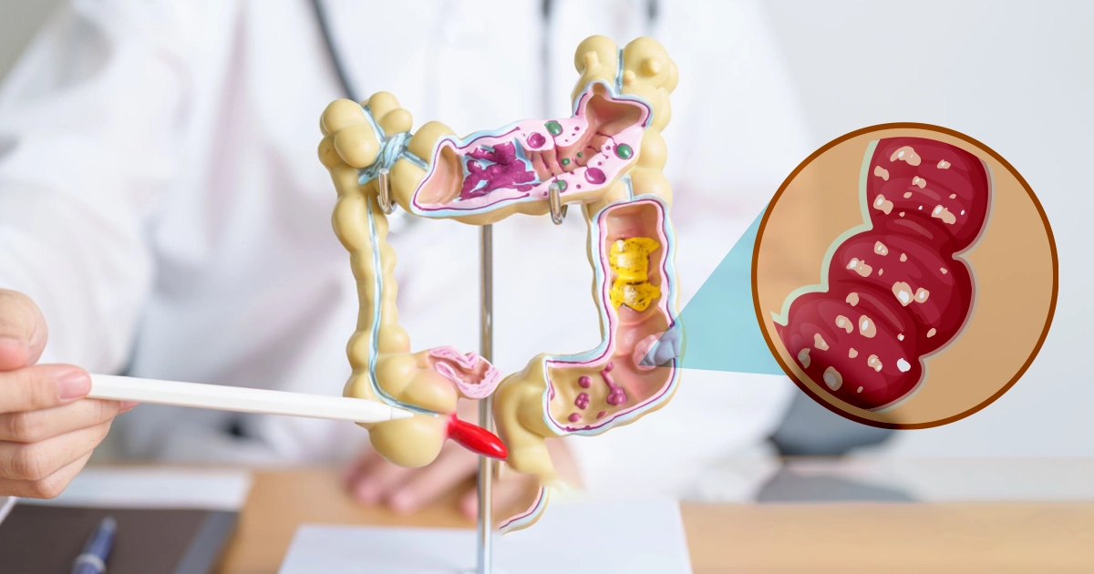 What Causes Irritable Bowel Syndrome