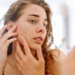 Woman examining acne on her face in a mirror