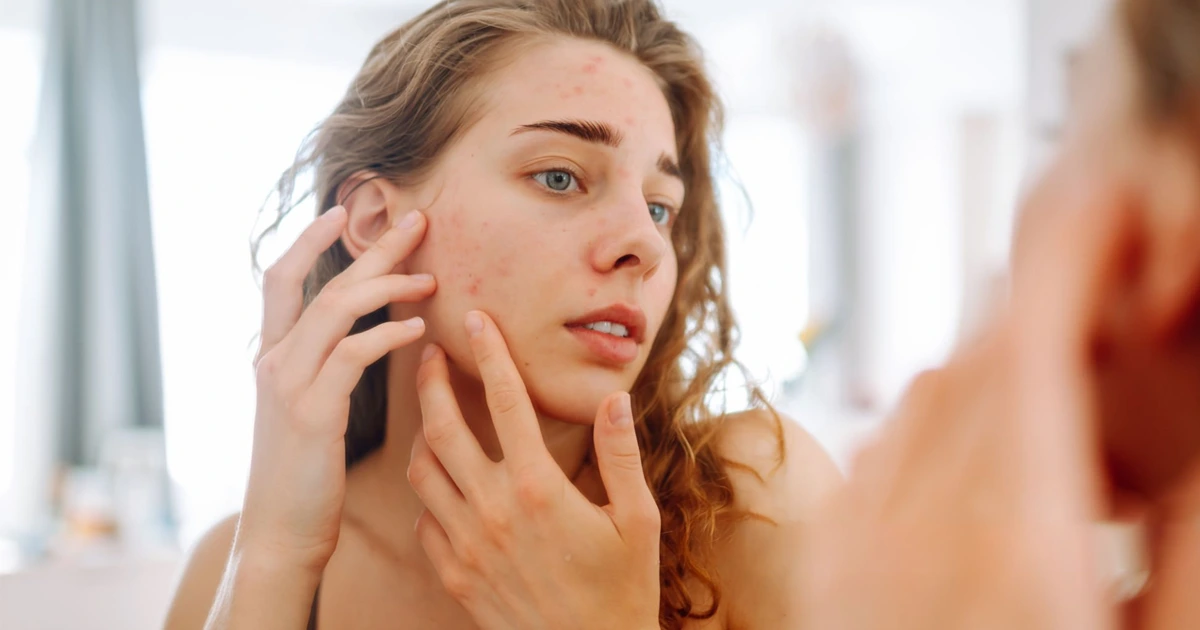 Can Skin Irritation Cause Acne