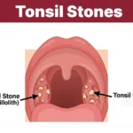 Medical illustration of tonsil stones.