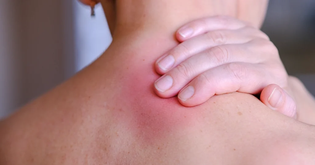 Arm skin irritation from heat rash condition.