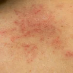 Shoulder skin irritation from heat rash condition.