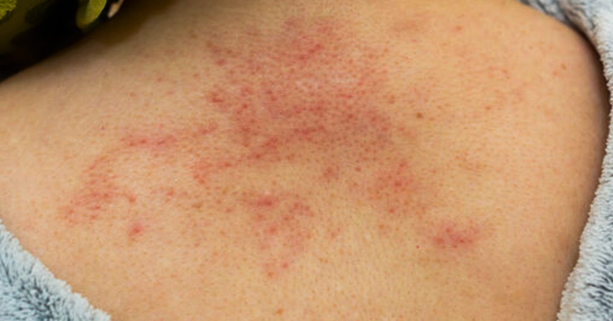 How Long Does Heat Rash Last