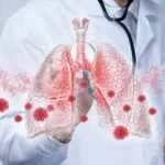 Lung infection diagram showing contagious pneumonia spread