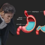 Woman with stomach pain next to GERD comparison diagram.