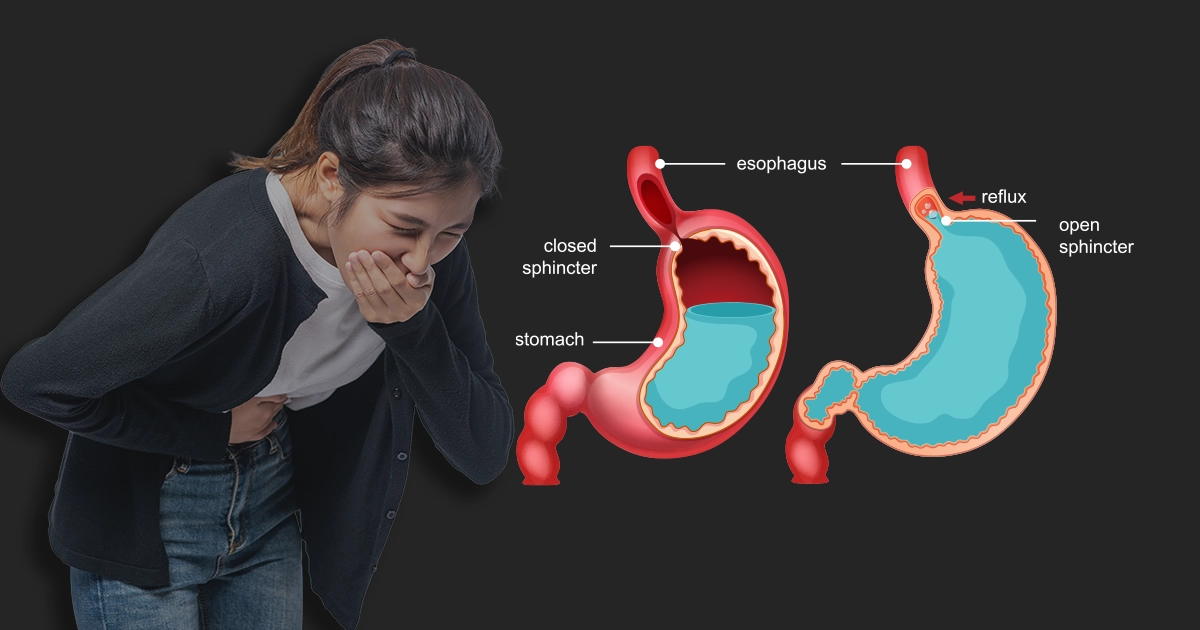 Can Gerd Cause Nausea