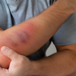 Man holding his bruised and swollen arm from a soft tissue injury.