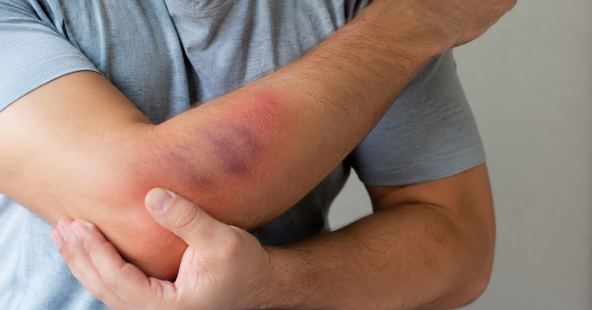 Soft Tissue Injury: Causes, Symptoms, Treatment & Recovery Time