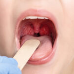 Close-up of a doctor examining a child’s inflamed throat with a tongue depressor.