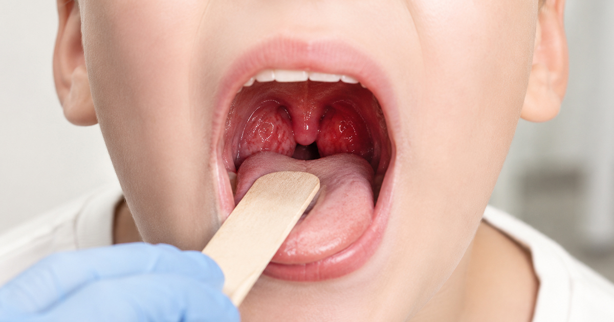 Is Tonsillitis Contagious?