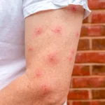 Multiple red, inflamed insect bites or rash marks on a person's skin, set against a brick wall background.