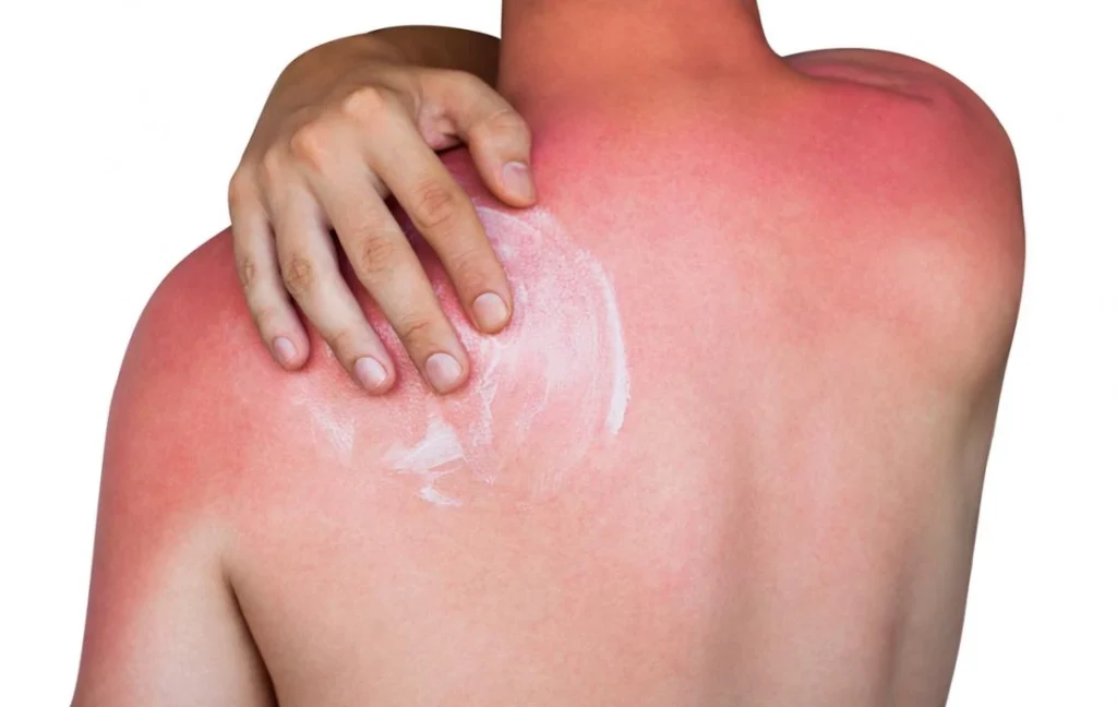 Person applying cream to a red sunburn on their upper back.