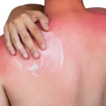 Person applying cream to a red sunburn on their upper back.