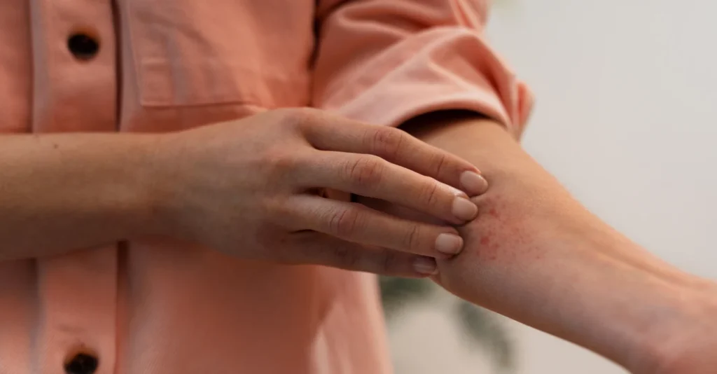 person-dealing-with-rosacea