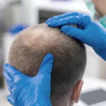 Doctor wearing blue gloves examining a patient's thinning hair.