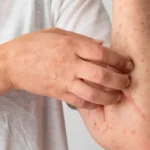 Anaphylaxis symptoms showing on scratched arm