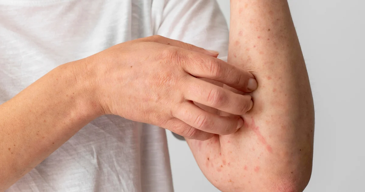 What Is Anaphylaxis?